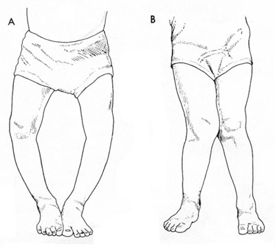 高级育婴师教程之观察O或X型腿发育过程